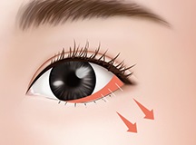 Outer Eye Slant Surgery